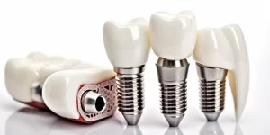 Dentysta Warszawa implanty